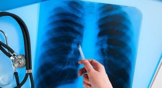 Флюорография спасает жизни: половину случаев туберкулёза выявляют на ранней стадии