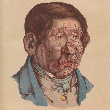 Новые случаи проказы найдены в Румынии и Хорватии