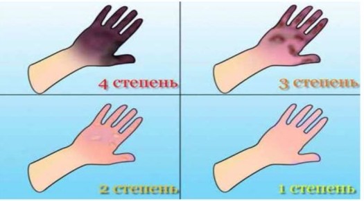 Случаев отморожения нет. Минздрав сообщает, что по оперативной информации лечебно-профилактических учреждений республики, на утро 2 февраля в стационарные учреждения не поступали граждане с отморожениями