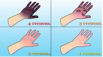 Случаев отморожения нет. Минздрав сообщает, что по оперативной информации лечебно-профилактических учреждений республики, на утро 2 февраля в стационарные учреждения не поступали граждане с отморожениями