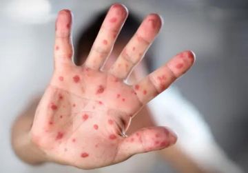 Три случая кори зарегистрировали в Кишинёве с начала года - один в январе, два в феврале