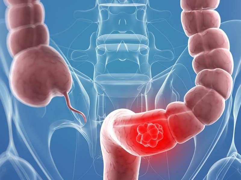 У 30-летних россиян всё чаще выявляют рак кишечника — онкологи