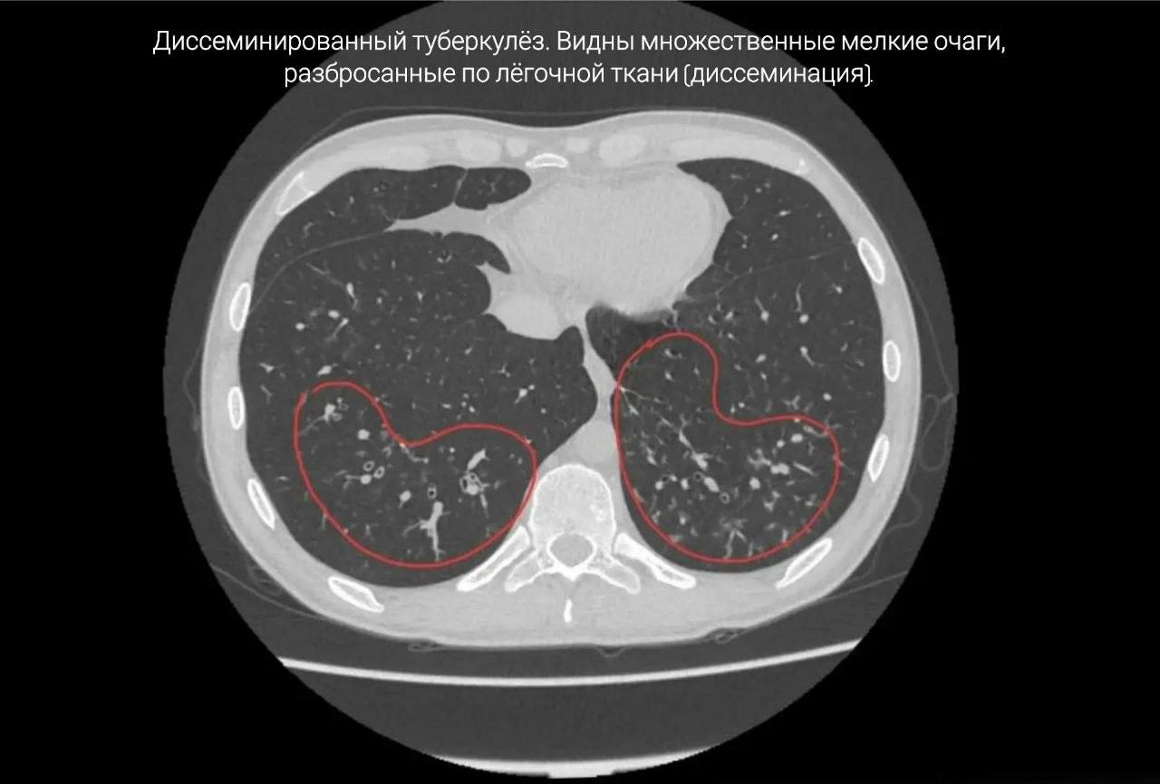 Мужик умер после 17 лет курения электронок и кальянов — к 33 годам его легкие убило пневмонией, туберкулезом и необратимым фиброзом